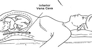 Lying on Your Back During Exercise – Why Do Some Pregnant Women Get Dizzy?