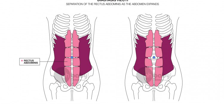 “Why do I still have a pooch after baby?” The Basics of Abdominal Separation and How to Fix It!