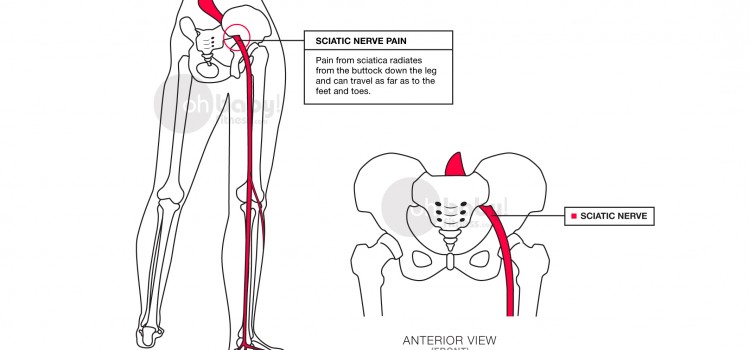 Sciatic pain during pregnancy: How exercise can help